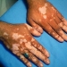 Vitiligo