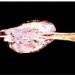 Bone Cancer
