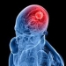 Brain Tumour