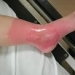 Burns