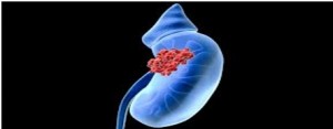 Kidney Cancer