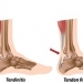 achilles-tendinitis