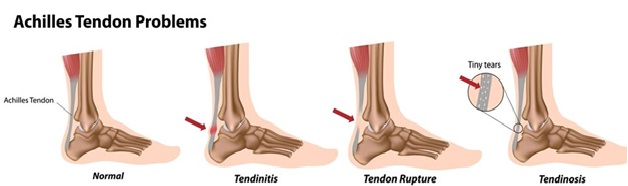 achilles-tendinitis