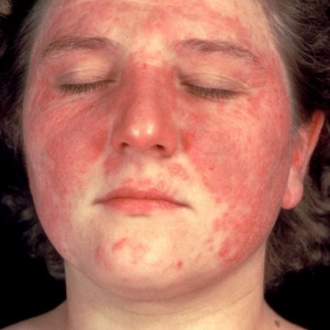 Acne Rosacea