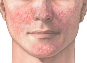 Acne Vulgaris