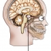 Craniopharyngioma