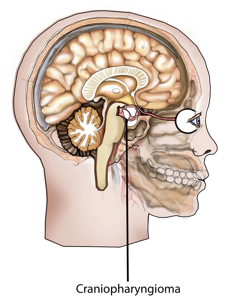 Craniopharyngioma