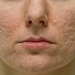 Pitted Acne Scars