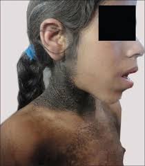 Rabson-Mendenall Syndrome