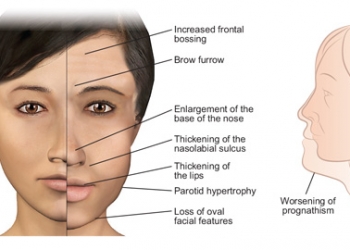 Acromegaly