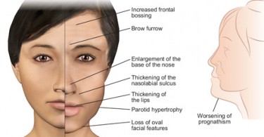 Zollinger Ellison Syndrome Natural Treatment Zollinger Ellison Syndrome Natural Treatment