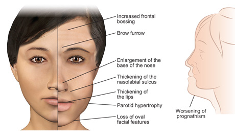 Acromegaly