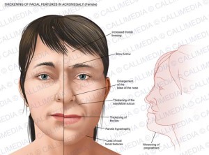 Acromegaly