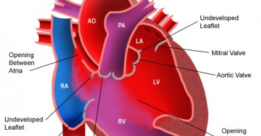 Natural Treatment For Fluid Around The Heart Natural Treatment For Fluid Around The Heart