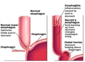esophagus esophagitis barretts esophageal hernia oesophagus hiatal reflux larynx stomach pharynx gerd gastroesophageal esfago fundoplication