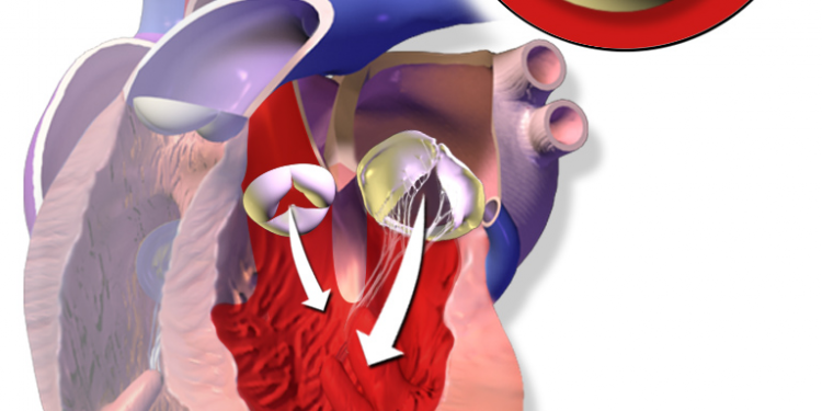 HEART VALVE REGURGITATION CAUSES SYMPTOMS AND TREATMENT visual data 5