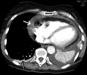 Dressler’s syndrome