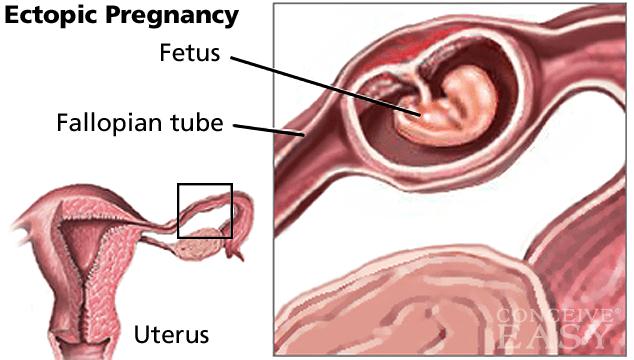 Ectopic Pregnancy