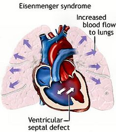 Eisenmenger Syndrome