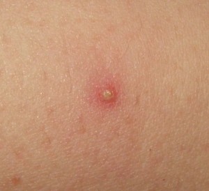 Folliculitis