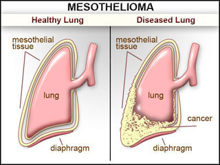 Mesothelioma Causes, Symptoms, Diagnosis and Treatment - Natural ...