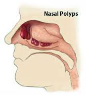 Nasal Polyps