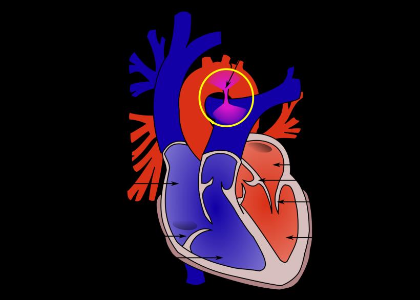 Patent Ductus Arteriosus