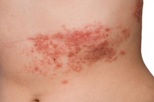 Shingles