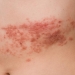 Shingles