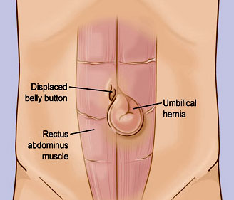 Umbilical Hernia