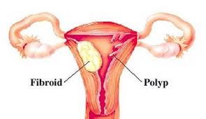 Uterine Polyps