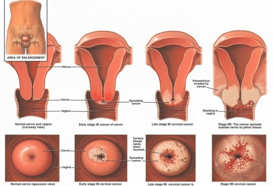 Vulvar Cancer