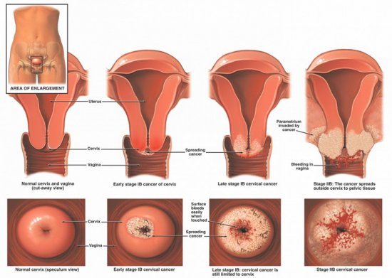 Vulvar Cancer