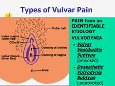 Vulvodynia