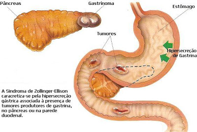 Zollinger-Ellison Syndrome