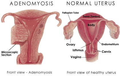 adenomyosis