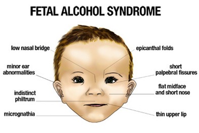 Signs Of Fetal Alcohol Syndrome