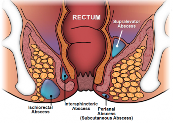 Anal Fistula