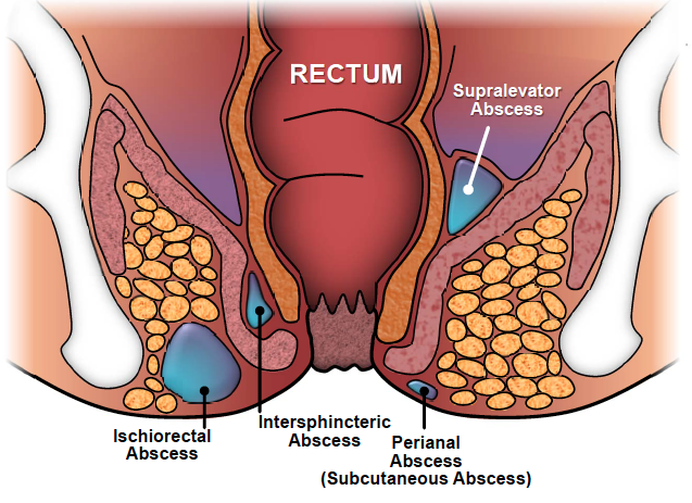 Anal Fistula