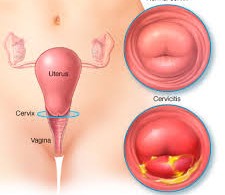 cryosurgery and sex and abdomen pain cryosurgery and sex and abdomen pain