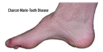 Charcot Marie Tooth Disease