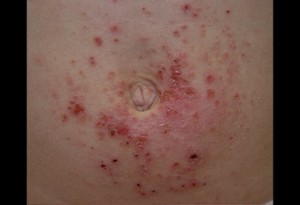 Contact Dermatitis