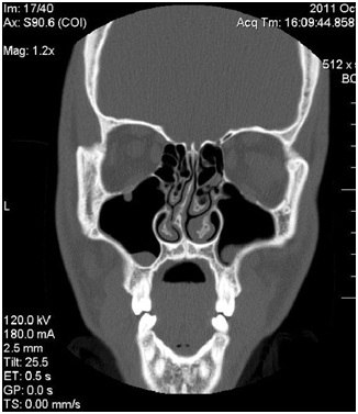 Deviated Septum