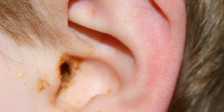 Ear Infection (Middle Ear) Causes, Symptoms, Diagnosis and Treatment