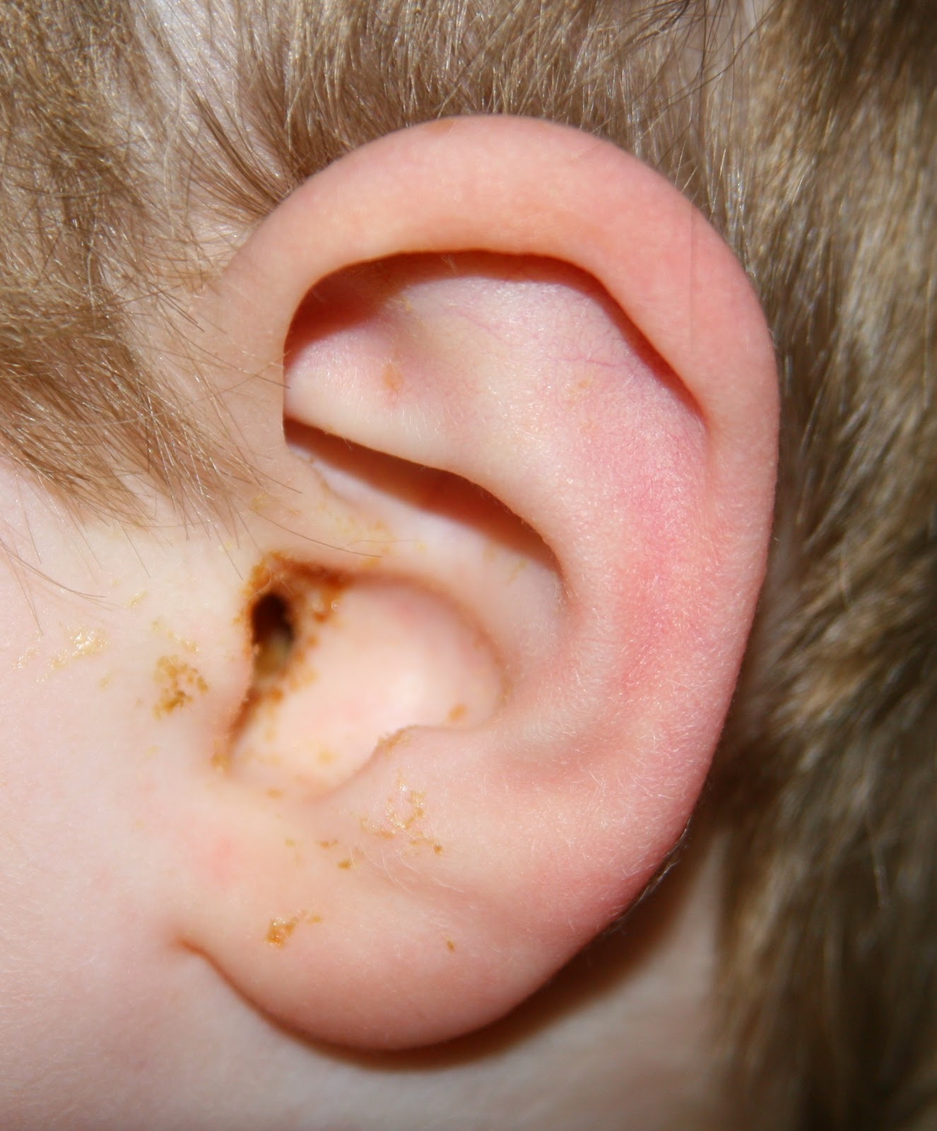 signs ear infection