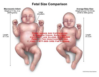 Fetal Macrosomia