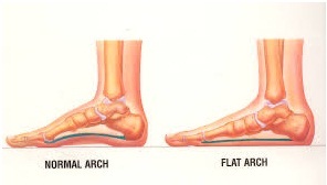 Flat Feet