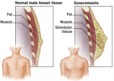 Galactorrhea