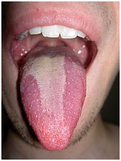 Geographic Tongue