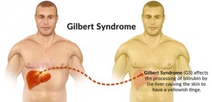 gilbert diagnosis